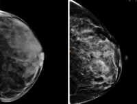 two mammogram images